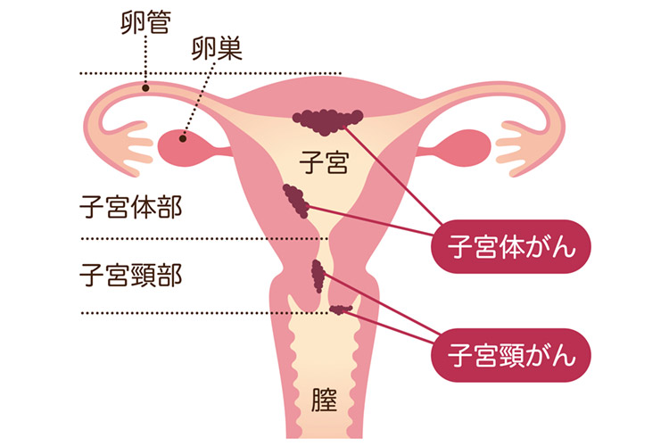 婦人科領域のがんの種類画像