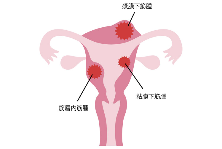 子宮や卵巣の病気イメージ